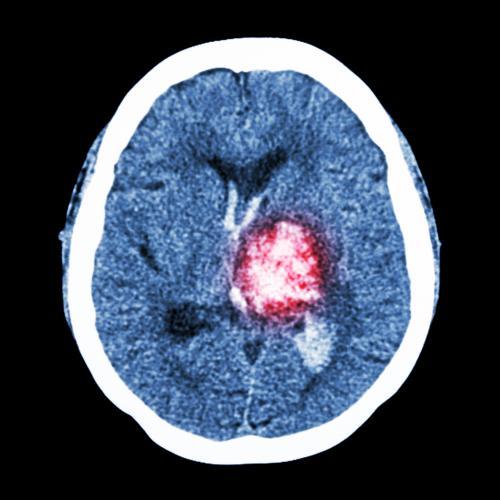 Hemorrhage in the Brain Causes Damage that Cannabinoids Can Stop